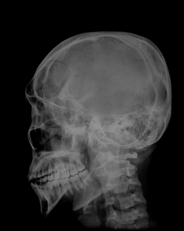 Free A Schedel Ap Radiograph Of The Skull Black Background Nohat Cc