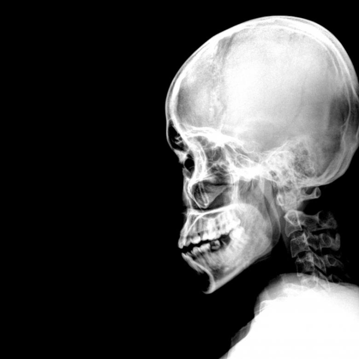 Free A Schedel Ap Radiograph Of The Skull Black And White Nohat Cc