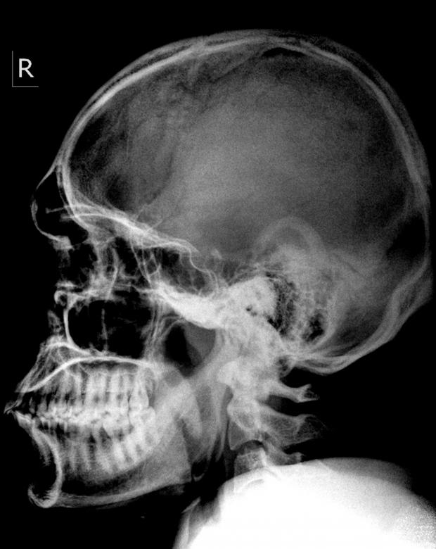 Free A Schedel Ap Radiograph Of The Head And Neck Nohat Cc