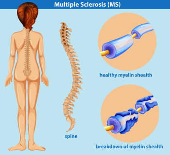 National Multiple Sclerosis Society MS Walk Awareness ribbon Orange ribbon,  Multiple Sclerosis transparent background PNG clipart