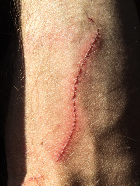 arm,cut,skin,curve,heal,healing,hurt,injury,pain,scab,scar,scarred,scratch,scratched,wound,wrist