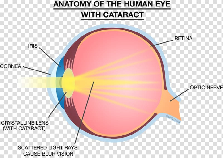 Free: Light Eye Lens Strength Training Anatomy Cataract, light transparent  background PNG clipart 