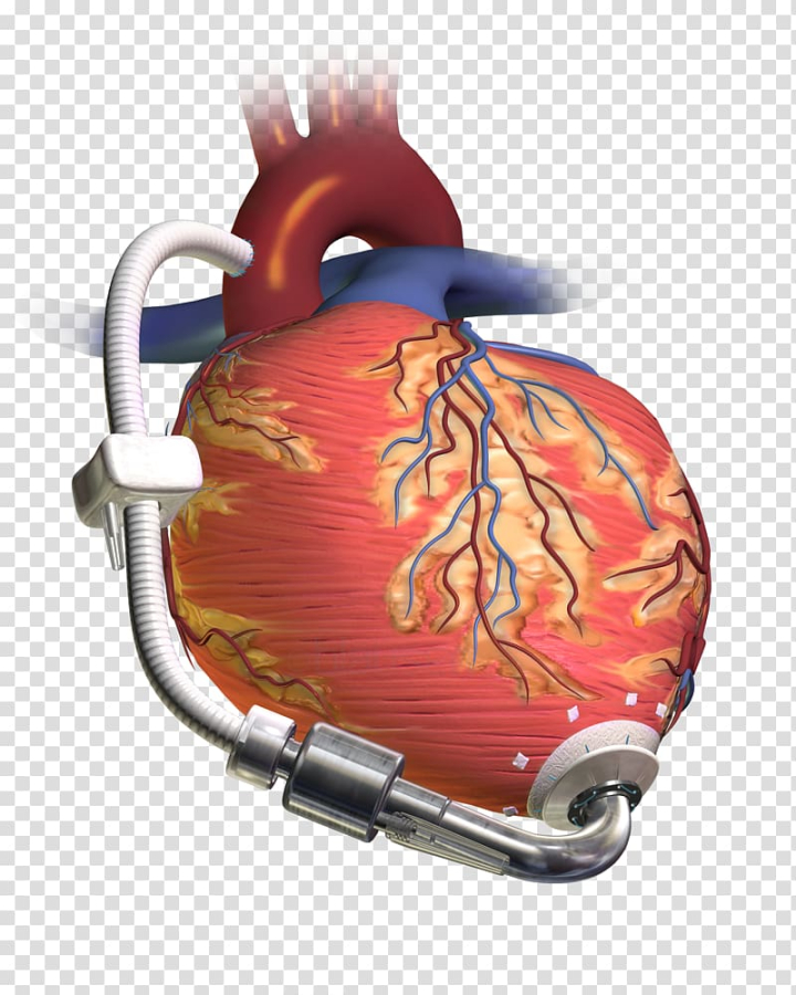 ventricular,assist,device,heart,transplantation,artificial,ventricle,left,medicine,patient,organ transplantation,organ,heart valve,heart rate,cardiology,cardiac surgery,artificial heart valve,ventricular assist device,heart transplantation,artificial heart,heart ventricle,left ventricle,png clipart,free png,transparent background,free clipart,clip art,free download,png,comhiclipart