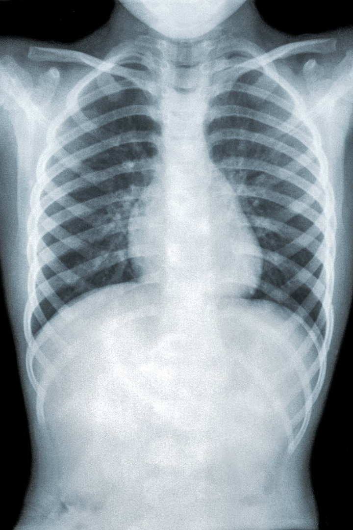 x ray,science,public domain,medical,chest,sick,chest x ray,radiation,film,film photo,laboratory,photography,rawpixel