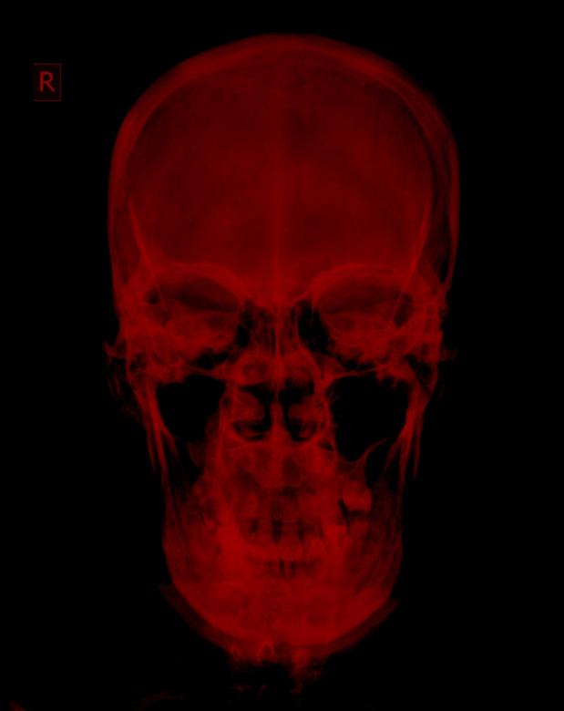 skull,xray,anatomy,asian,background,bone,brain,care,diagnosis,doctor,examination,face,film,head,health,hospital,human,image,imaging,incident,injury,isolated,lateral,man,medical,medicine,neck,neurological,neurology,orthopedic,patient,people,physical,radiation,radiograph,radiography,radiological,radiologist,radiology,ray,scan,science,skeleton,spine,technology,therapy,vertebrate,xrayimages,xrays,netstockvault