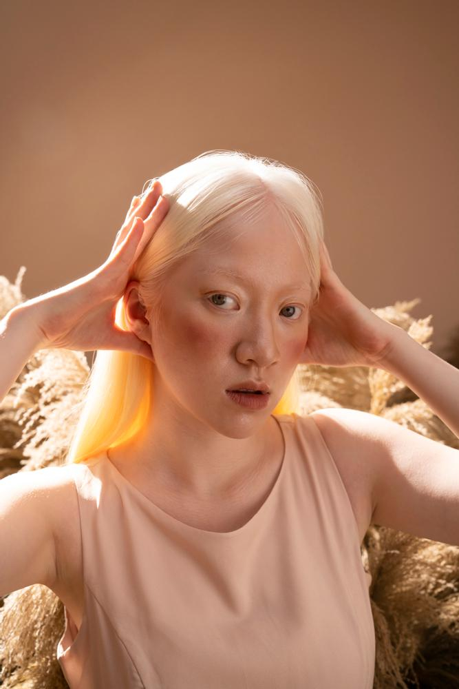 asian people with albinism